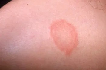 Skin Rashes: Causes, Symptoms and Effective Home Remedies