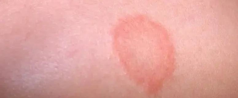 Skin Rashes: Causes, Symptoms and Effective Home Remedies